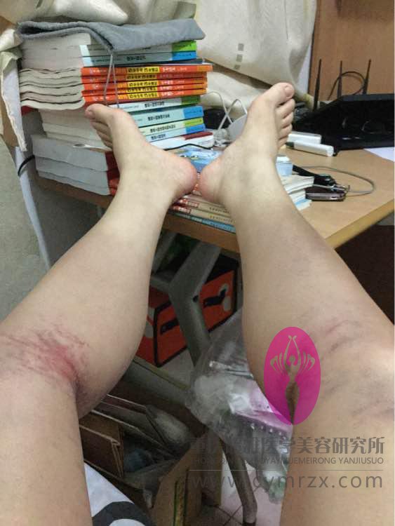 拒绝抽脂,wǒ要超 声 波减肥 拒绝抽脂,wǒ要超 声 波减肥