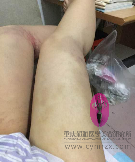 拒绝抽脂,wǒ要超 声 波减肥 拒绝抽脂,wǒ要超 声 波减肥