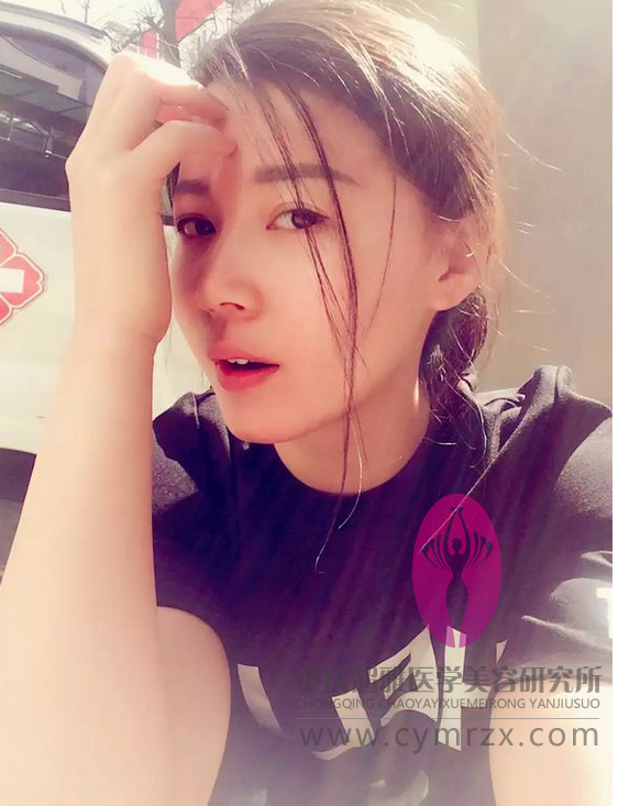 讲真,我对超声波双眼皮的效果挺满意的608 讲真,我对超声波双眼皮的效果挺满意的608