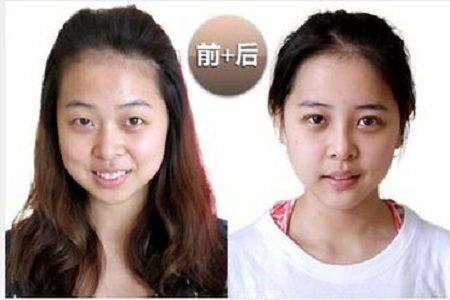 再也不用担心割双眼皮的价格了，重庆超雅帮你解决268