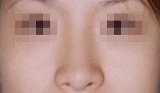 说一说我所知道的玻尿酸复合成骨因子隆鼻039 说一说我所知道的玻尿酸复合成骨因子隆鼻039