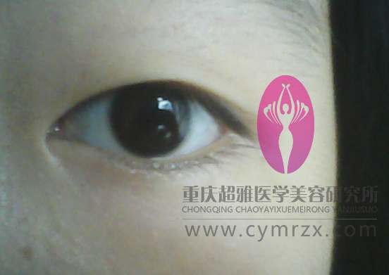 后天去重庆超雅做超 声 波双眼 皮，求围观