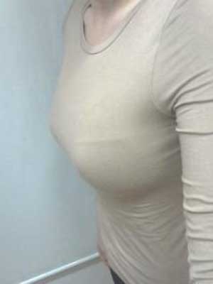 超声波自体脂肪丰胸半年的样子，穿比基尼好美啊540
