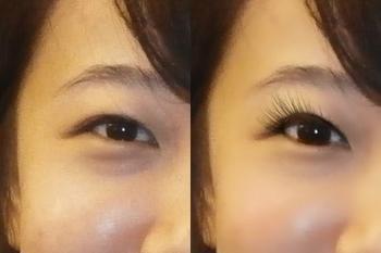 超 声 波去眼袋效果太好啦 超 声 波去眼袋效果太好啦