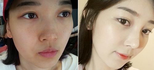 wǒ选超雅玻尿酸复合成骨因子隆鼻wǒ美丽 wǒ选超雅玻尿酸复合成骨因子隆鼻wǒ美丽