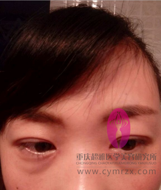 超 声 波去眼袋——精辟而不普通 超 声 波去眼袋——精辟而不普通