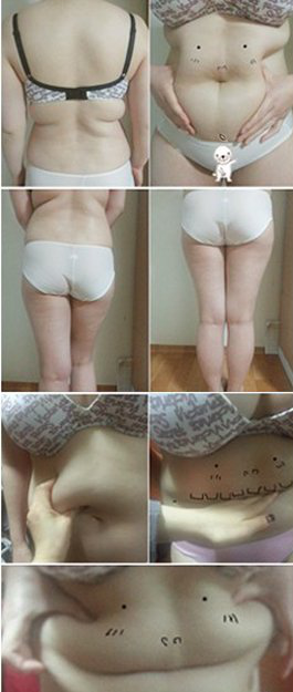用超声波自体脂肪丰胸减了个肥又丰了个胸，美美哒132
