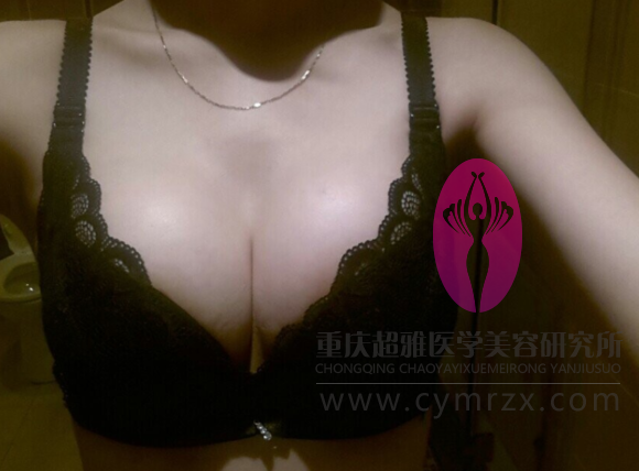 用超声波自体脂肪丰胸减了个肥又丰了个胸，美美哒132
