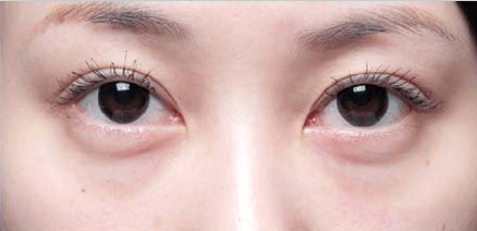 还有什么比超 声 波去眼袋更快速去除眼袋得呢? 还有什么比超 声 波去眼袋更快速去除眼袋得呢?
