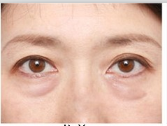 我去除眼袋的秘籍659 我去除眼袋的秘籍659