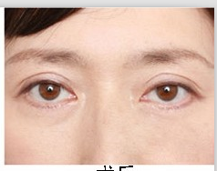 我去除眼袋的秘籍659 我去除眼袋的秘籍659