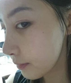 超声波去眼袋不可能毁容的862 超声波去眼袋不可能毁容的862