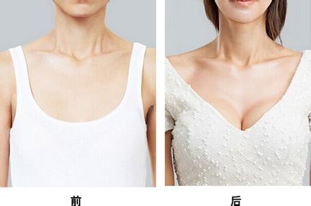超 声 波自体脂肪隆胸——让妈妈开心 超 声 波自体脂肪隆胸——让妈妈开心