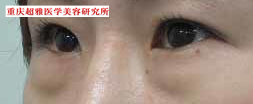 超声波祛眼袋让我又有婚姻了914 超声波祛眼袋让我又有婚姻了914