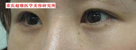 超声波祛眼袋让我又有婚姻了914 超声波祛眼袋让我又有婚姻了914