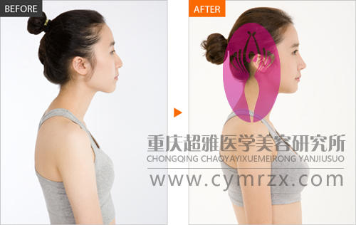 超声波自体脂肪隆胸让我的身材我做主234 超声波自体脂肪隆胸让我的身材我做主234