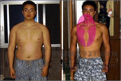超 声 波减肥让200斤得宅男轻松瘦到140斤 超 声 波减肥让200斤得宅男轻松瘦到140斤