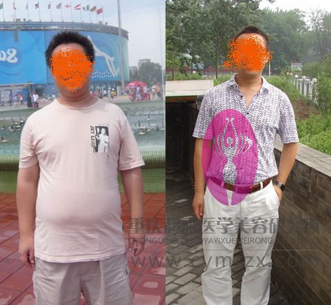 超 声 波减肥让wǒ爸爸远离三高