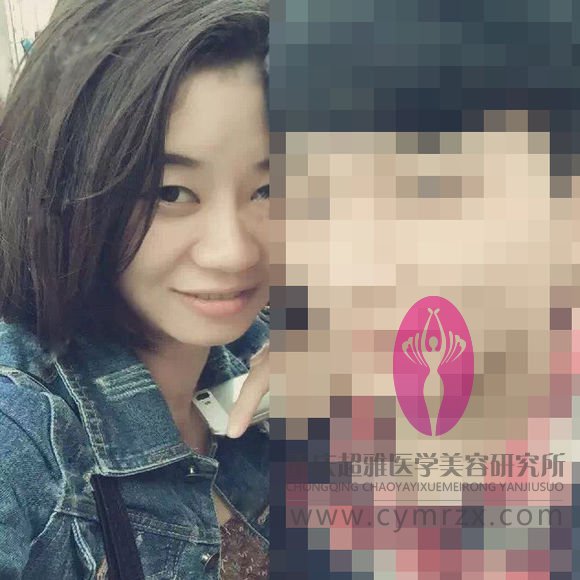在超雅整形医院做的不开刀隆鼻,吼吼,分享下180 在超雅整形医院做的不开刀隆鼻,吼吼,分享下180