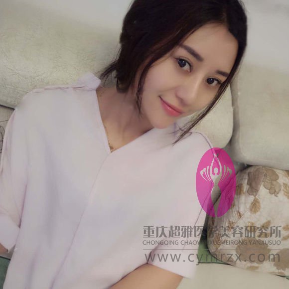 在超雅整形医院做的不开刀隆鼻,吼吼,分享下180 在超雅整形医院做的不开刀隆鼻,吼吼,分享下180