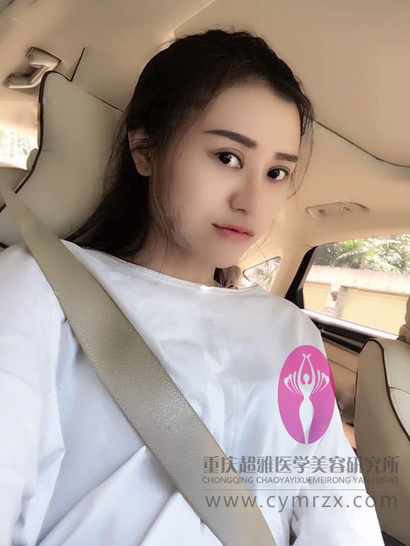 在超雅整形医院做的不开刀隆鼻,吼吼,分享下180 在超雅整形医院做的不开刀隆鼻,吼吼,分享下180