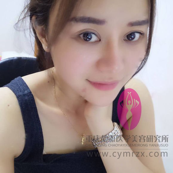 在超雅整形医院做的不开刀隆鼻,吼吼,分享下180 在超雅整形医院做的不开刀隆鼻,吼吼,分享下180