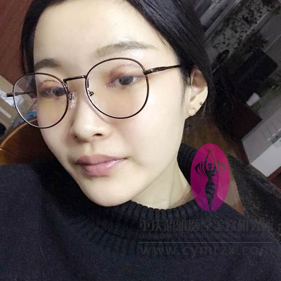 和朋友做的超声波双眼皮相比，我的全切双眼皮好像失败了658