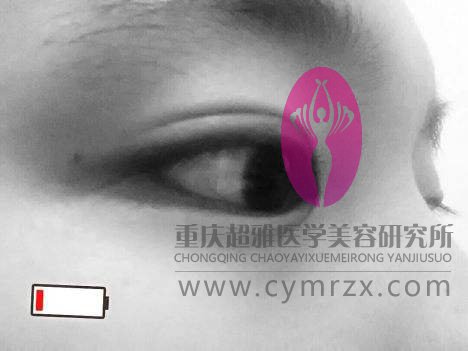 和朋友做的超声波双眼皮相比，我的全切双眼皮好像失败了658