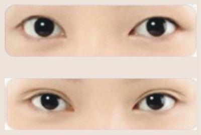 美女双眼皮676