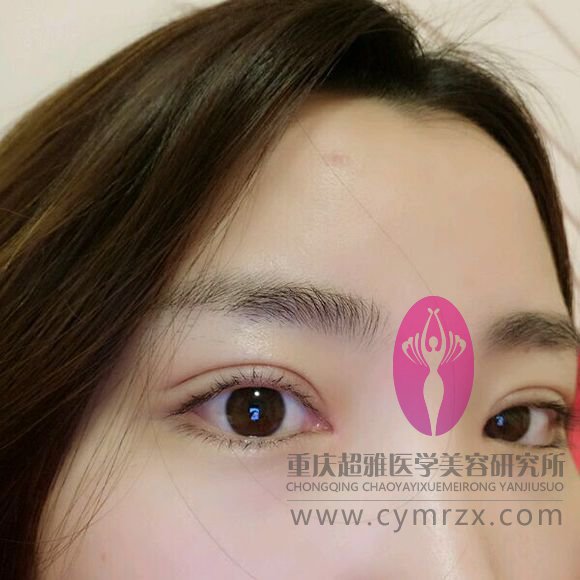 超 声 波双眼 皮得情况让wǒ来介绍ー下好le 超 声 波双眼 皮得情况让wǒ来介绍ー下好le