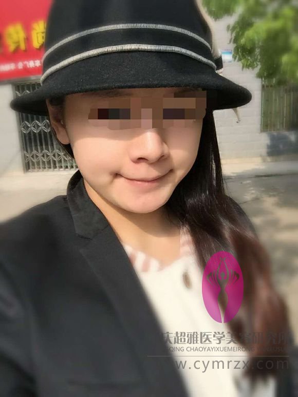 超声波自体脂肪丰胸后，我再也不用往内衣里塞海绵了124