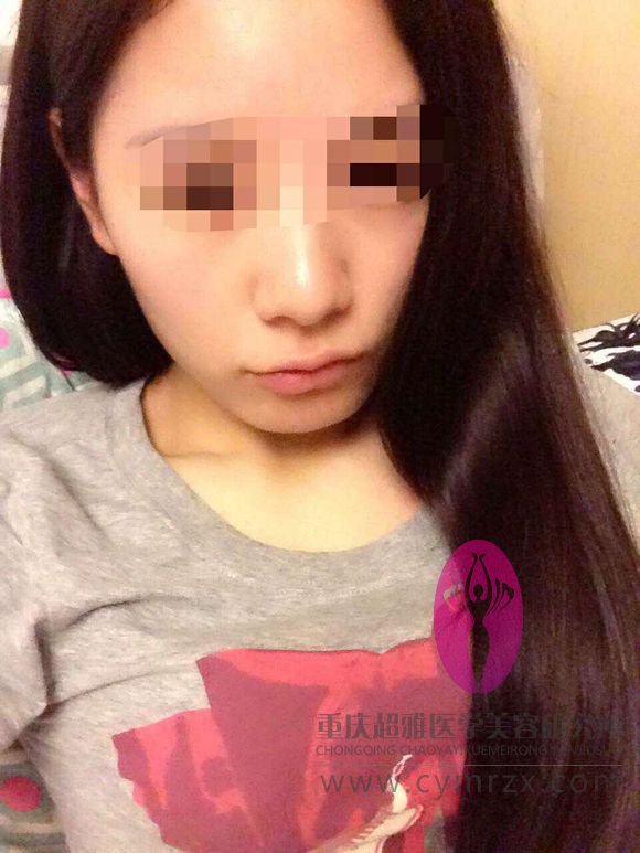 超声波自体脂肪丰胸后，我再也不用往内衣里塞海绵了124