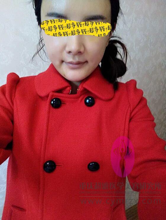 超声波自体脂肪丰胸后，我再也不用往内衣里塞海绵了124