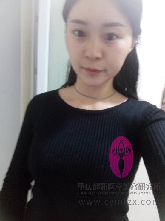 生完孩子乳房萎缩怎么办？wǒ用超 声 波自体脂肪丰胸