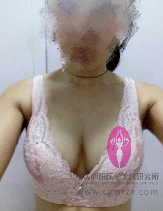 生完孩子乳房萎缩怎么办？wǒ用超 声 波自体脂肪丰胸