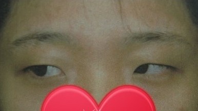 终于做了超声波双眼皮,摆脱死鱼眼093 终于做了超声波双眼皮,摆脱死鱼眼093