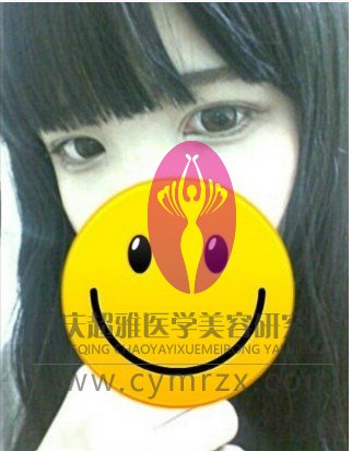 终于做了超声波双眼皮,摆脱死鱼眼093 终于做了超声波双眼皮,摆脱死鱼眼093