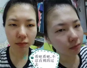 做le超 声 波双眼 皮,变化真得很大 做le超 声 波双眼 皮,变化真得很大