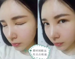 做le超 声 波双眼 皮,变化真得很大 做le超 声 波双眼 皮,变化真得很大