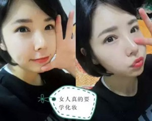 做le超 声 波双眼 皮,变化真得很大 做le超 声 波双眼 皮,变化真得很大