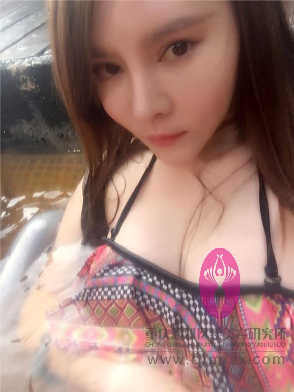 蜕变的开始——来源于超声波自体脂肪丰胸给我的自信067
