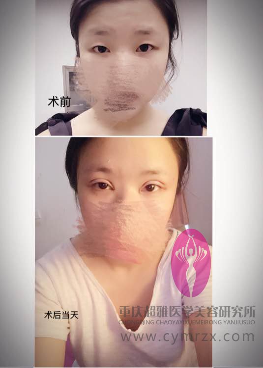 超声波双眼皮的恢复历程,我才做了没几天哦716 超声波双眼皮的恢复历程,我才做了没几天哦716