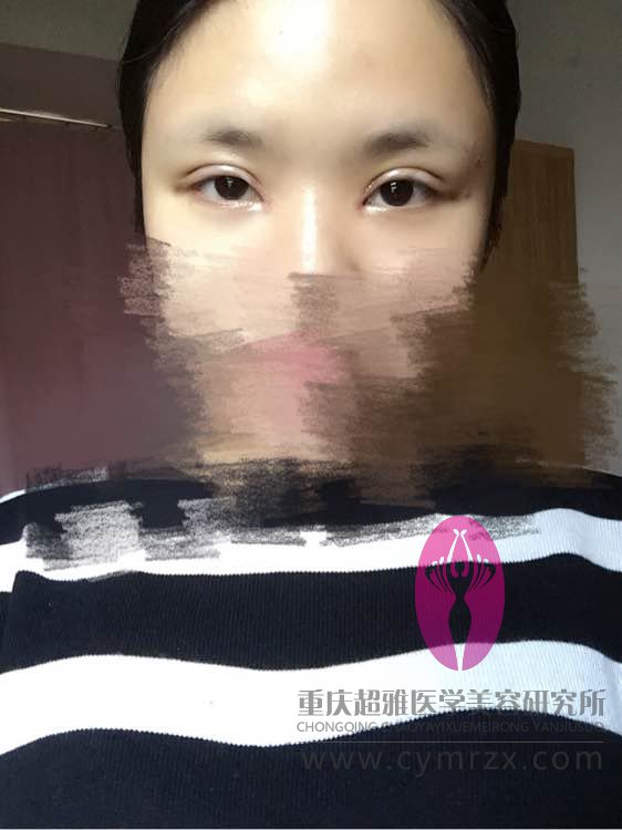 超声波双眼皮的恢复历程,我才做了没几天哦716 超声波双眼皮的恢复历程,我才做了没几天哦716