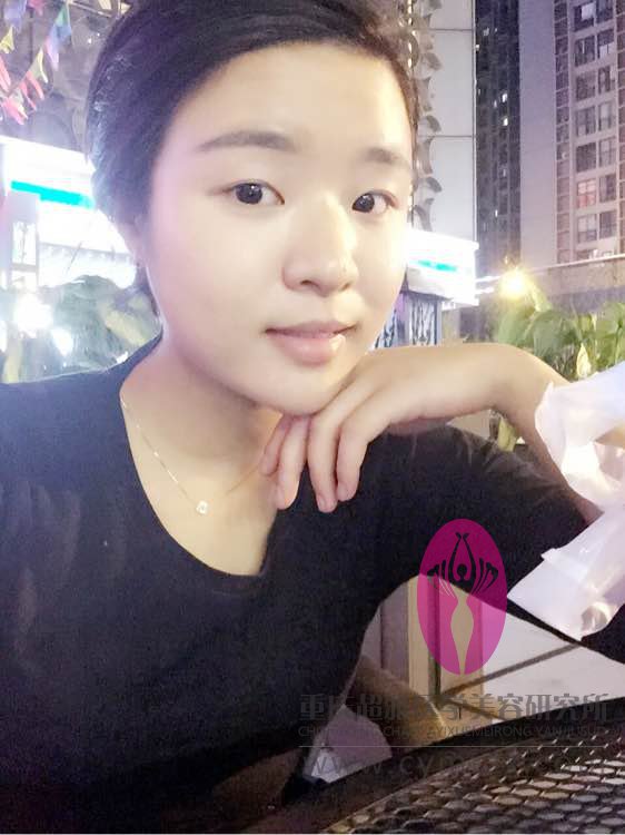 超声波双眼皮的恢复历程,我才做了没几天哦716 超声波双眼皮的恢复历程,我才做了没几天哦716