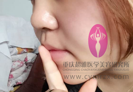不开刀隆鼻后的我,大家来看看吧780 不开刀隆鼻后的我,大家来看看吧780