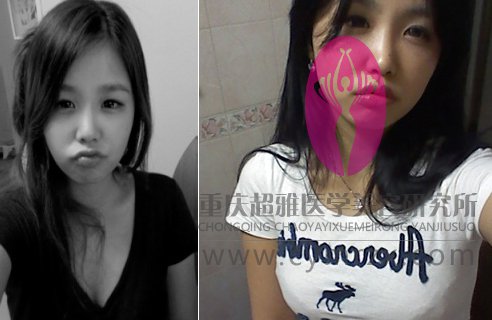 超声波自体脂肪丰胸让我有了从屌丝到女神的自然转变111