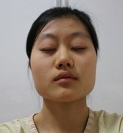 鼓足勇气做le超 声 波瘦脸,效果很好! 鼓足勇气做le超 声 波瘦脸,效果很好!