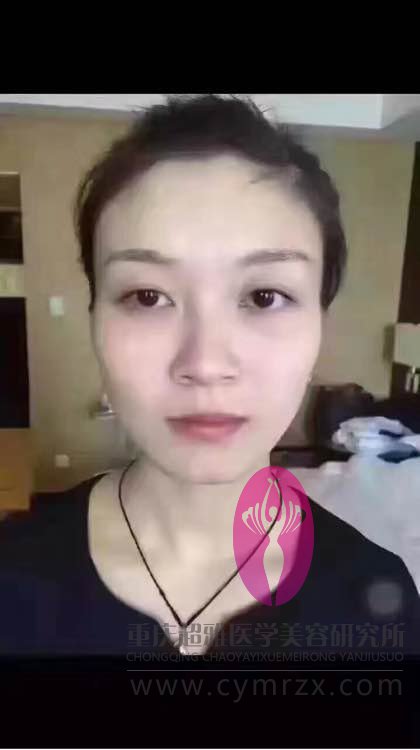 整容的魅力真大,看我的超声波双眼皮110 整容的魅力真大,看我的超声波双眼皮110