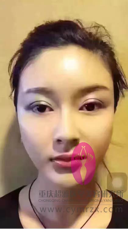 整容的魅力真大,看我的超声波双眼皮110 整容的魅力真大,看我的超声波双眼皮110