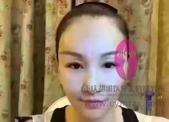 整容的魅力真大,看我的超声波双眼皮110 整容的魅力真大,看我的超声波双眼皮110